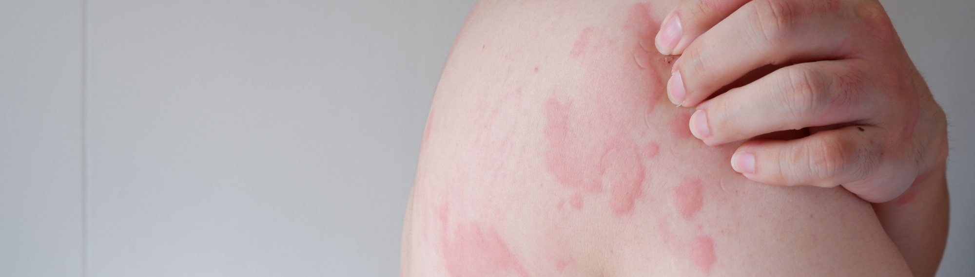 image of what causes kratom rash